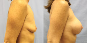Patient 60c Breast Augmentation Before and After