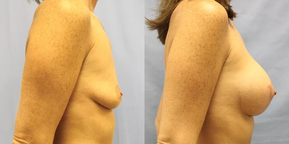 Patient 60c breast augmentation before and after