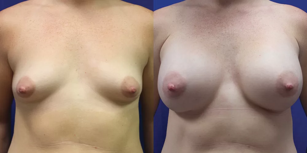 Patient 61a breast augmentation before and after