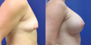 Patient 61c Breast Augmentation Before and After