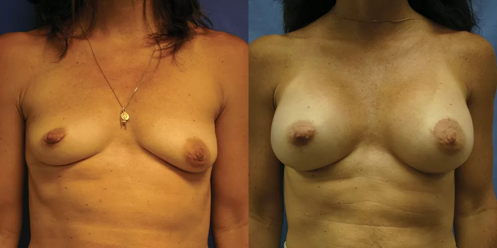 Patient 62a breast augmentation before and after