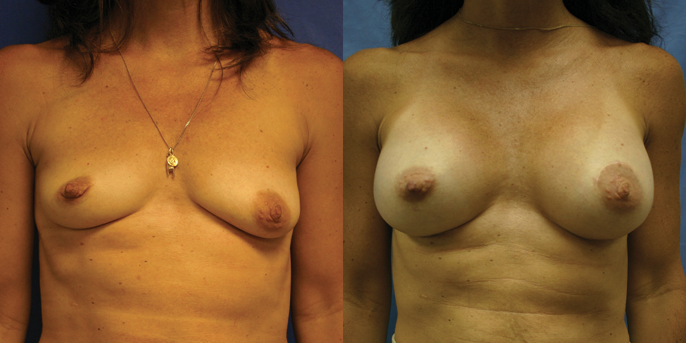 Patient 62a Breast Augmentation Before and After