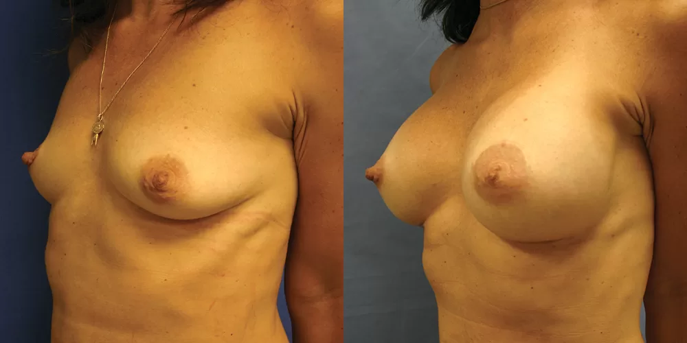 Patient 62b breast augmentation before and after
