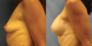 Patient 62c Breast Augmentation Before and After