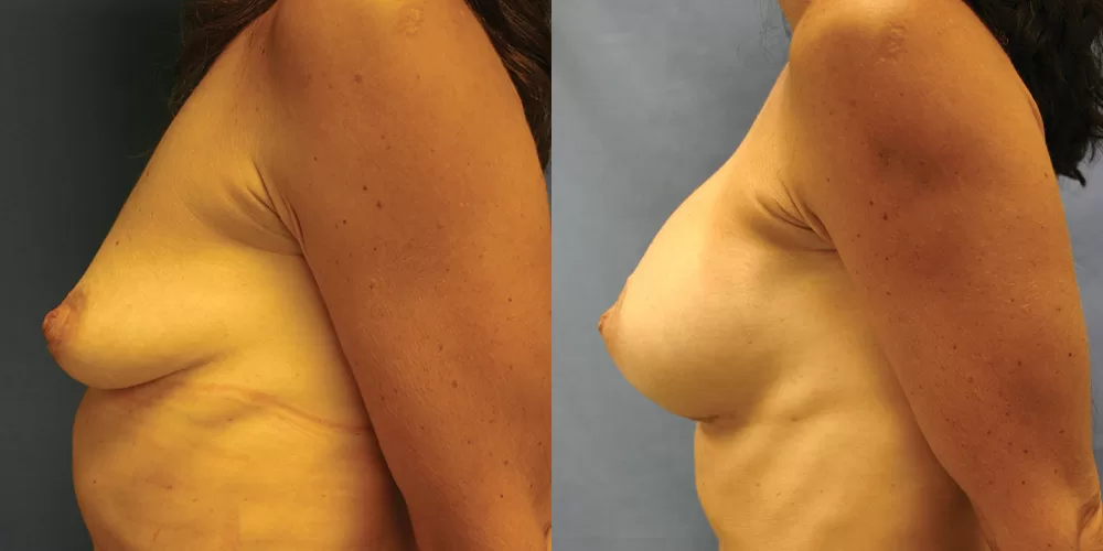 Patient 62c breast augmentation before and after