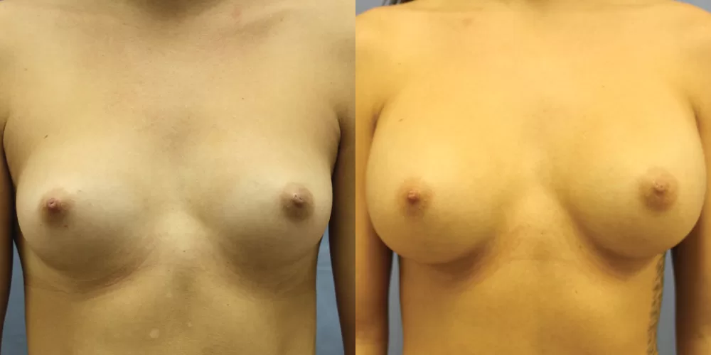 Patient 63a breast augmentation before and after