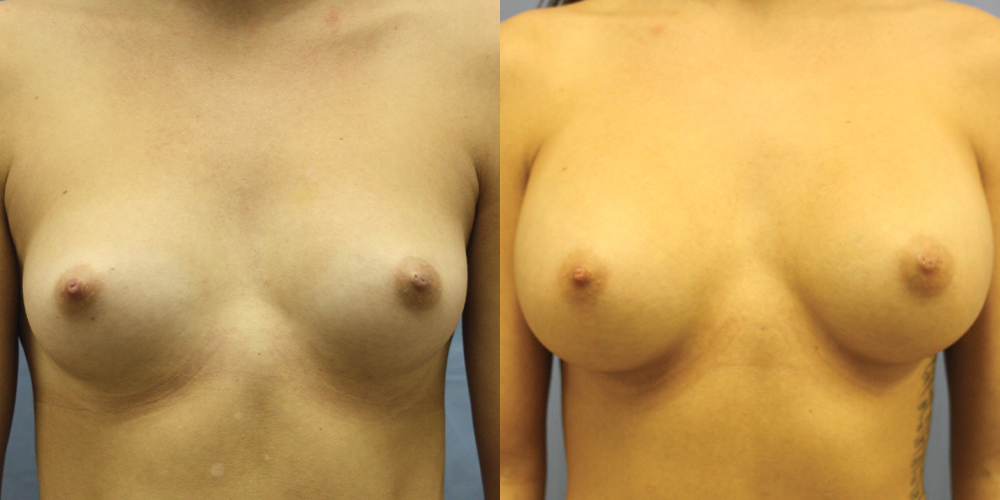 Patient 63a Breast Augmentation Before and After