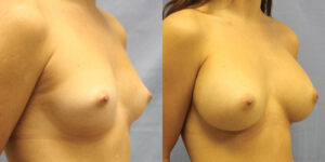 Patient 63b Breast Augmentation Before and After