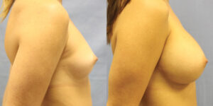Patient 63c Breast Augmentation Before and After