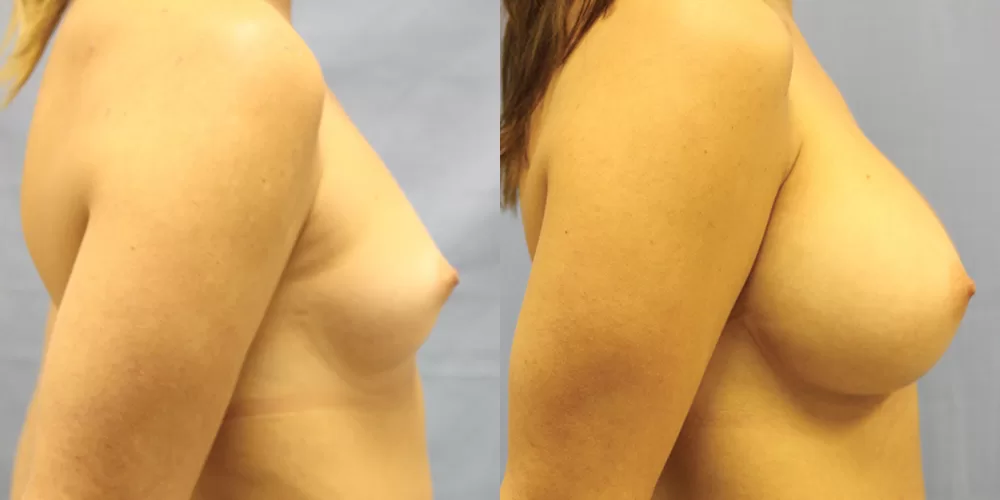 Patient 63c breast augmentation before and after