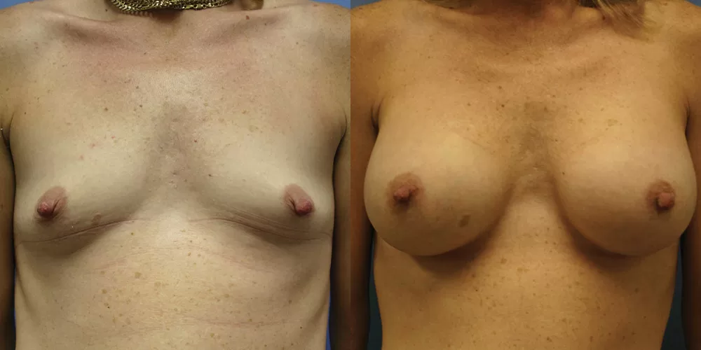 Patient 64a breast augmentation before and after