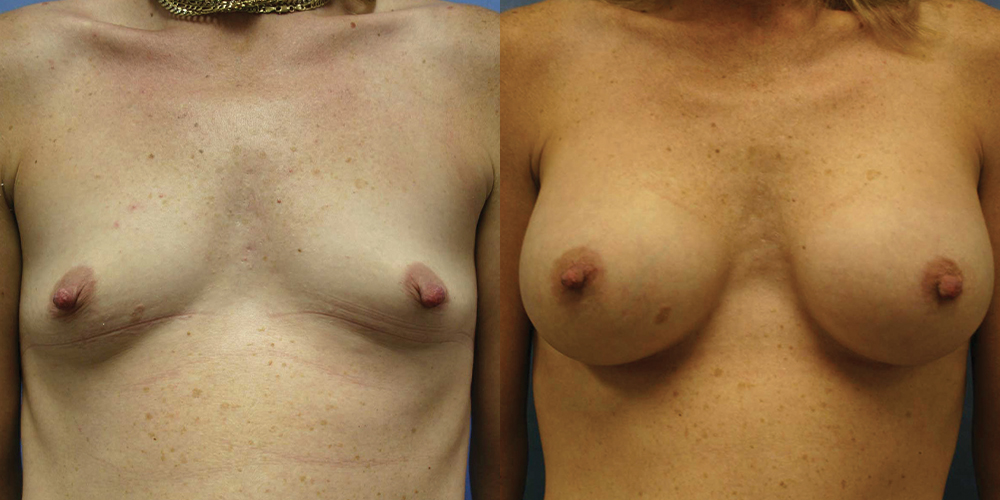 Patient 64a Breast Augmentation Before and After