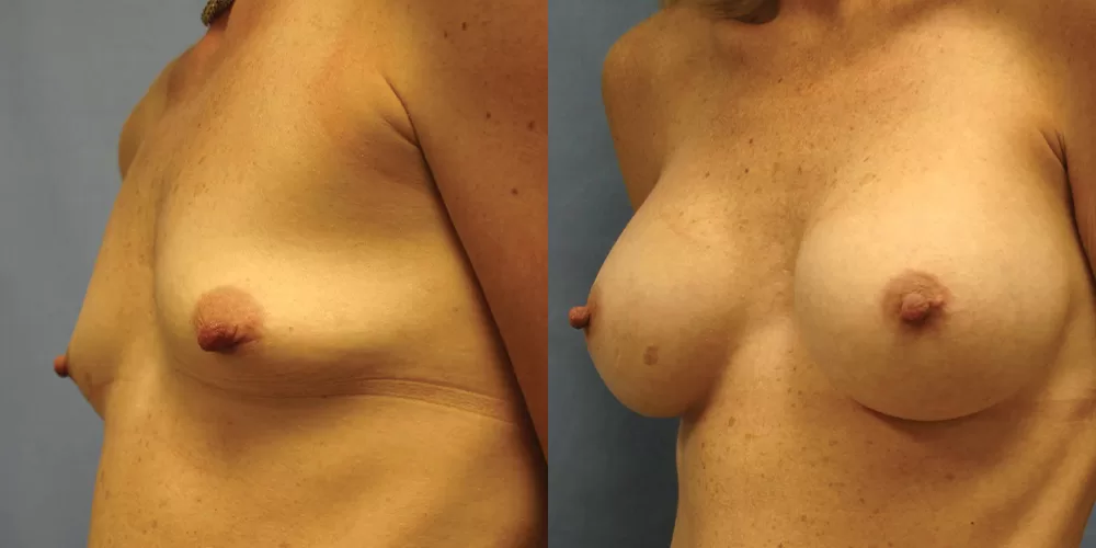 Patient 64b breast augmentation before and after