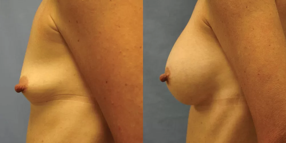 Patient 64c breast augmentation before and after