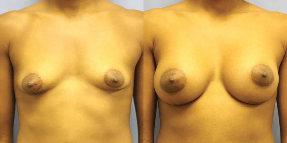 Patient 65a Breast Augmentation Before and After