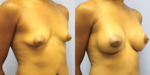 Patient 65b Breast Augmentation Before and After