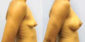Patient 65c Breast Augmentation Before and After
