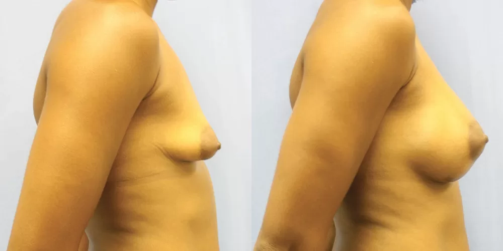 Patient 65c breast augmentation before and after