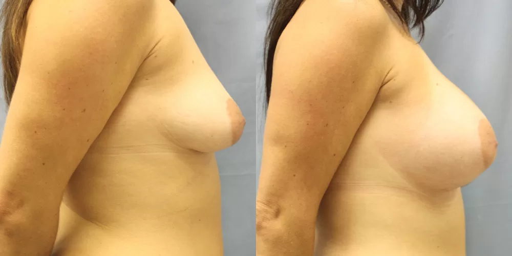 Patient 66c breast augmentation before and after