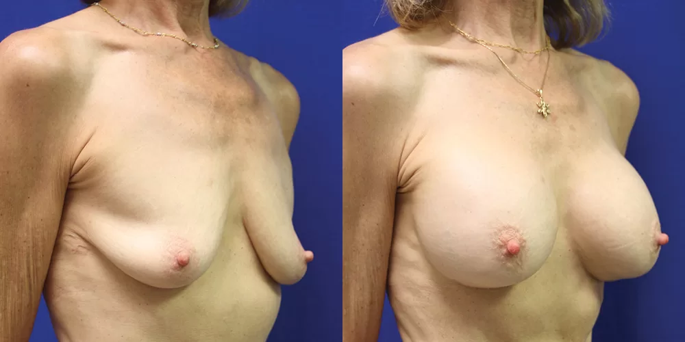 Patient 67b breast augmentation before and after