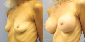 Patient 68b Breast Augmentation Before and After