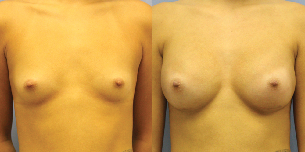 Patient 69a Breast Augmentation Before and After