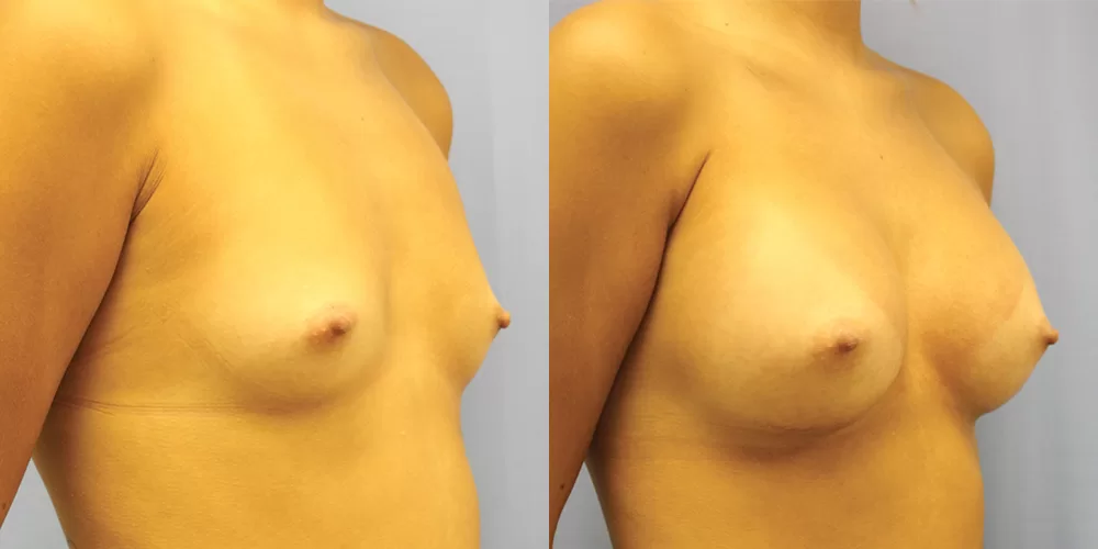 Patient 69b breast augmentation before and after