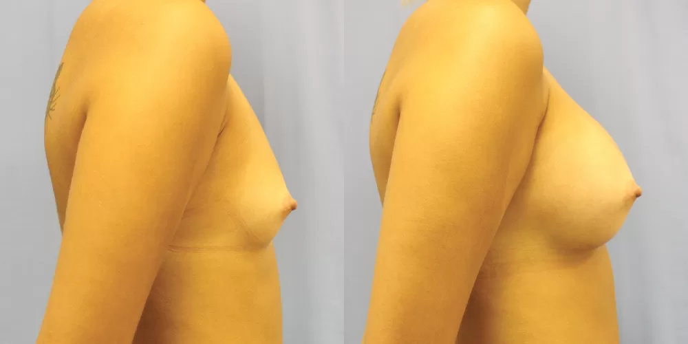 Patient 69c breast augmentation before and after