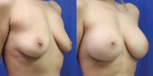 Patient 70b Breast Augmentation Before and After
