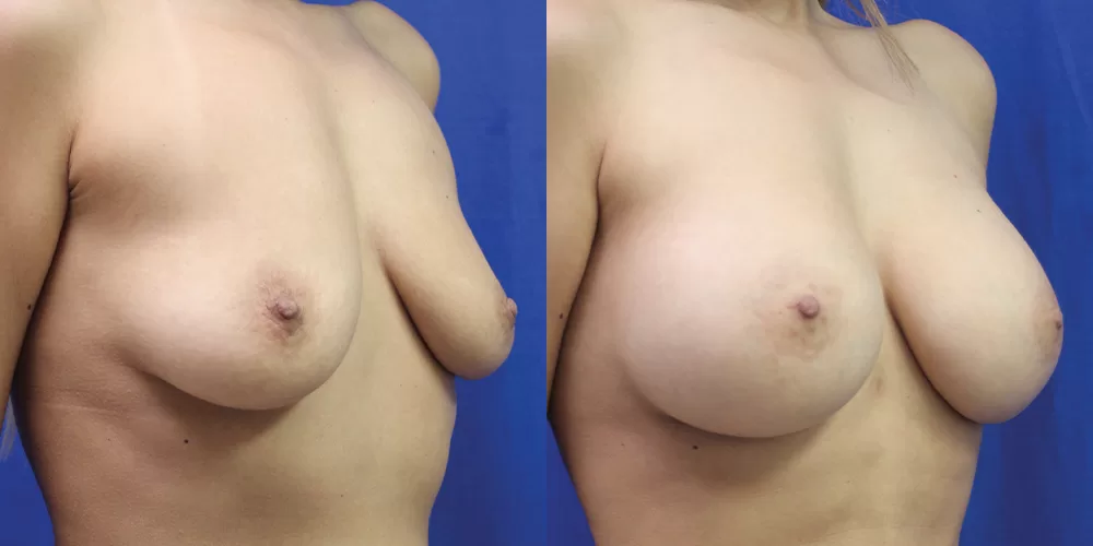 Patient 70b breast augmentation before and after