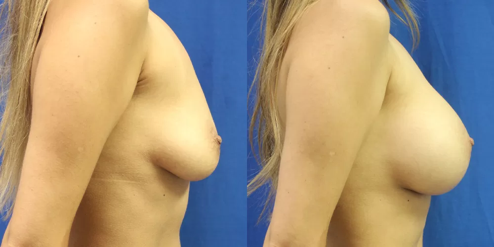Patient 70c breast augmentation before and after