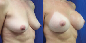 Patient 71b Breast Augmentation Before and After