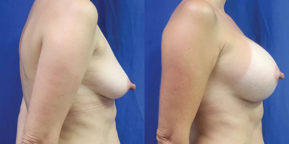 Patient 71c breast augmentation before and after