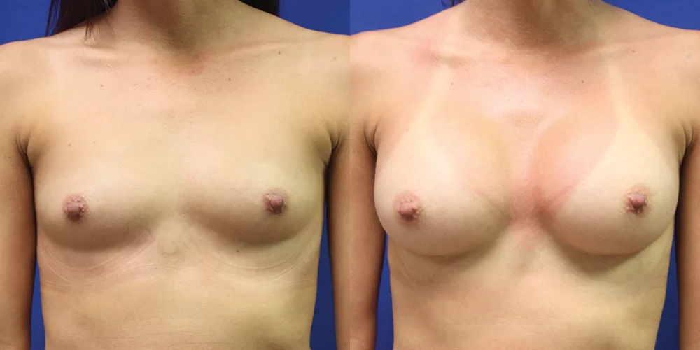 Patient 72a breast augmentation before and after