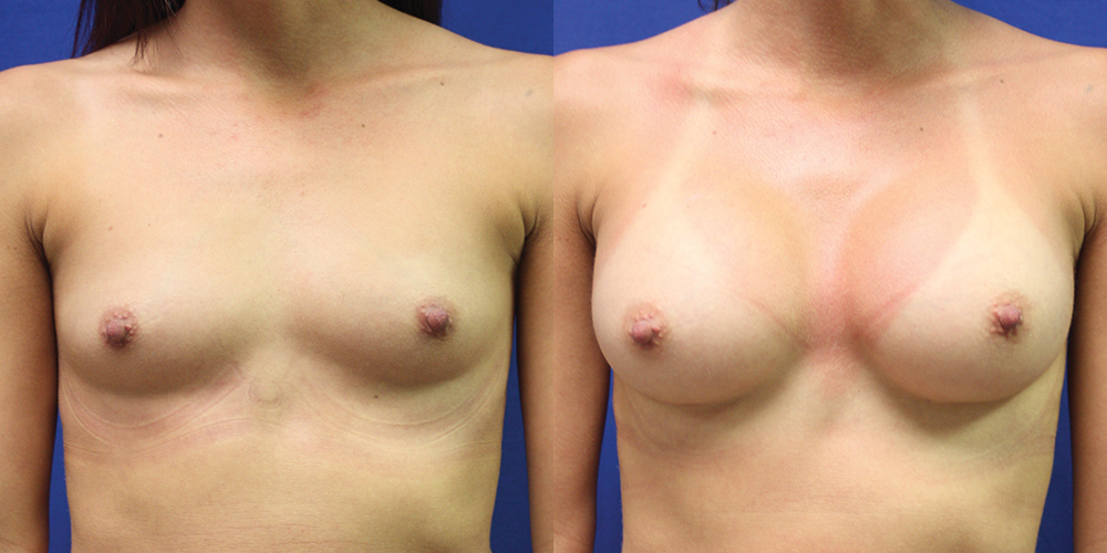 Patient 72a Breast Augmentation Before and After