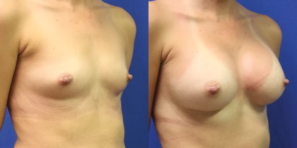 Patient 72b breast augmentation before and after