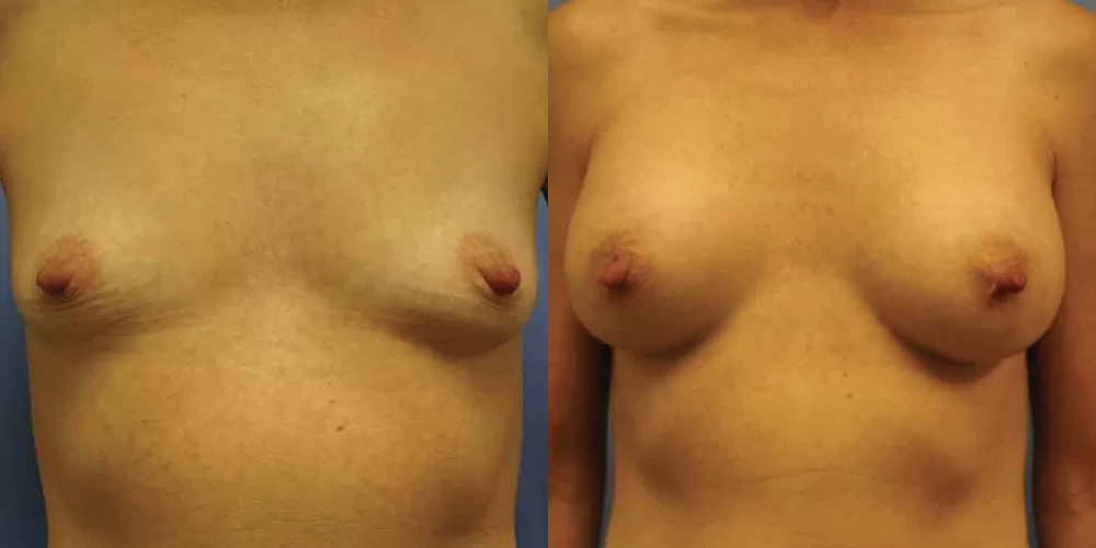 Patient 73a breast augmentation before and after
