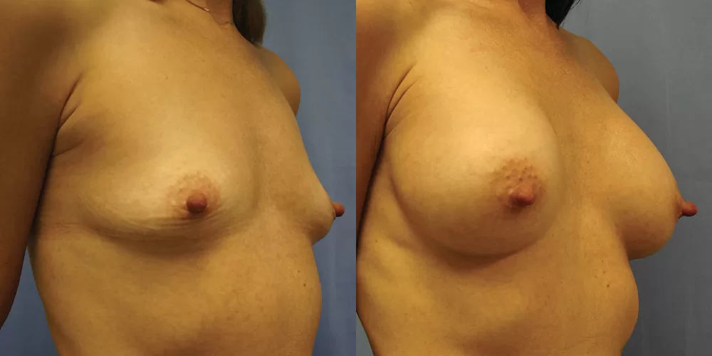 Patient 73b breast augmentation before and after