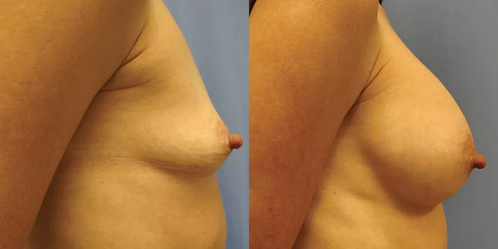 Patient 73c breast augmentation before and after