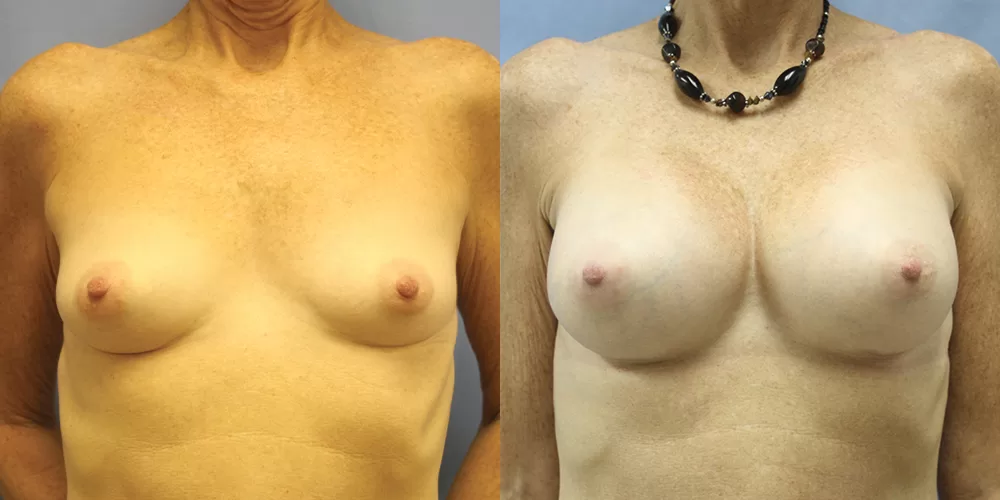 Patient 74a breast augmentation before and after