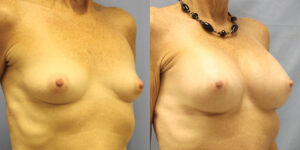 Patient 74b Breast Augmentation Before and After