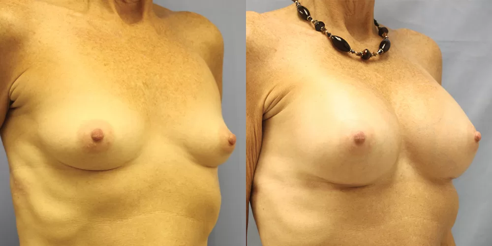 Patient 74b breast augmentation before and after
