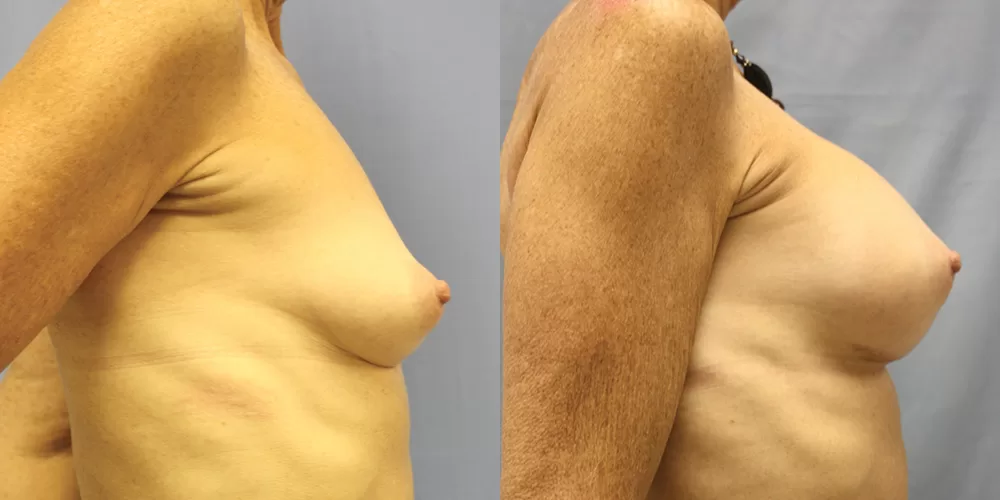 Patient 74c breast augmentation before and after
