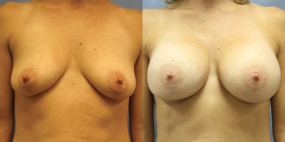 Patient 75a Breast Augmentation Before and After