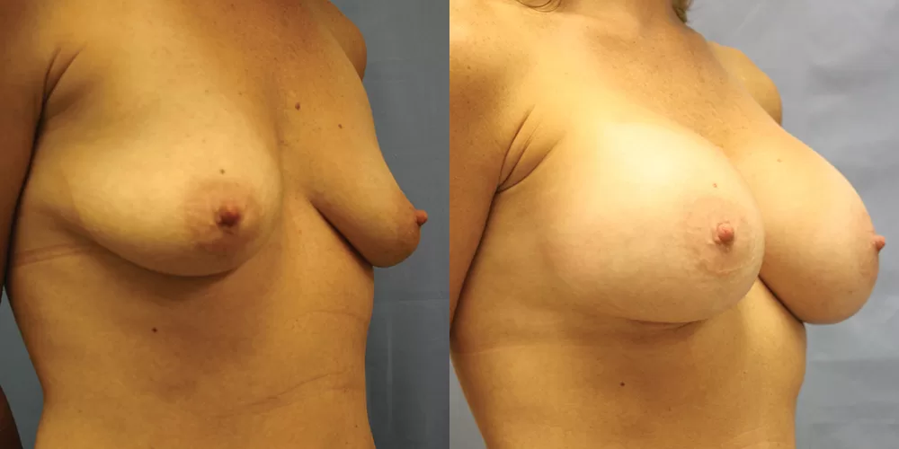 Patient 75b breast augmentation before and after