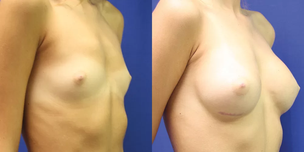 Patient 76b breast augmentation before and after