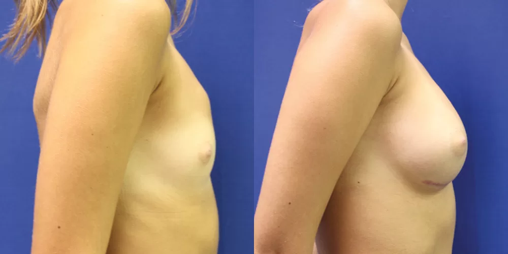 Patient 76c breast augmentation before and after