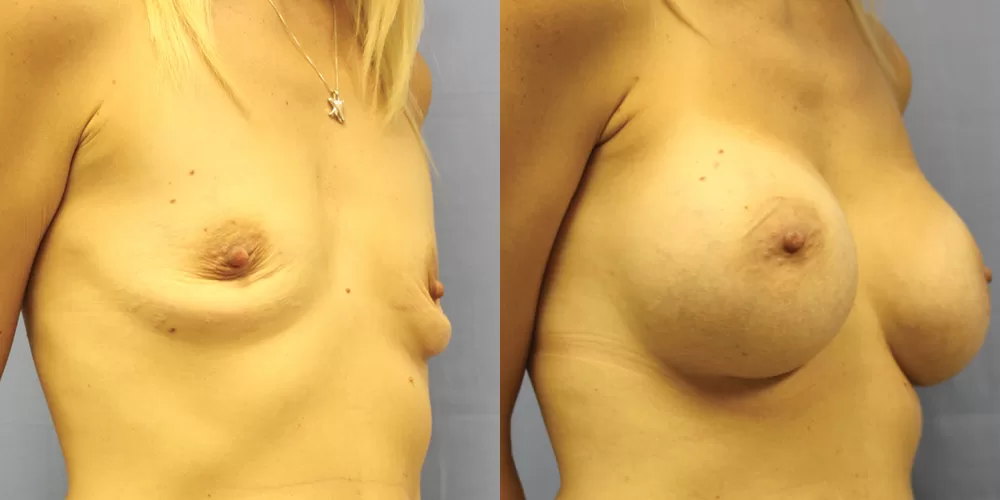 Patient 77b breast augmentation before and after