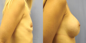 Patient 77c Breast Augmentation Before and After