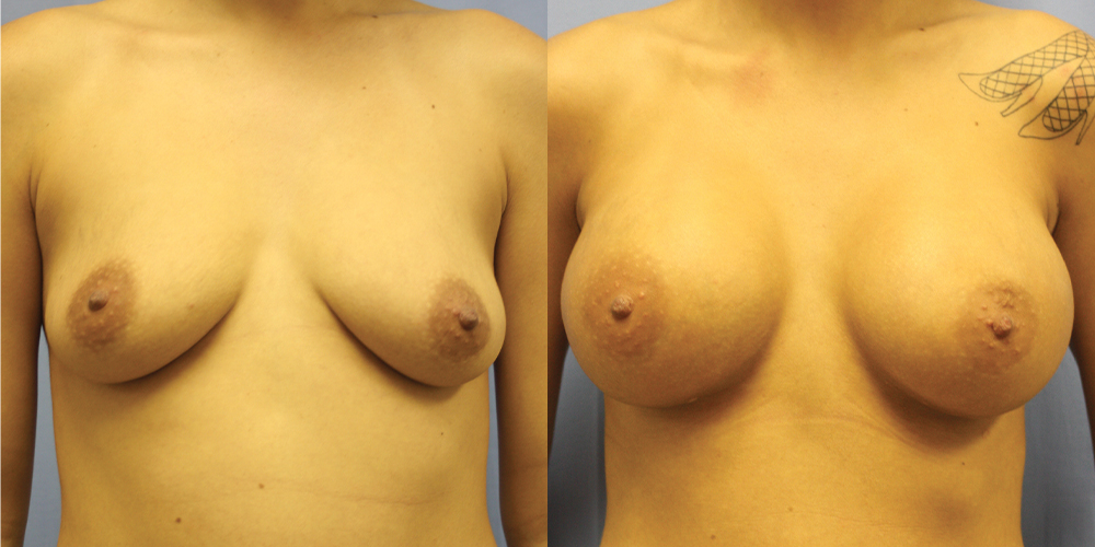 Patient 78a Breast Augmentation Before and After